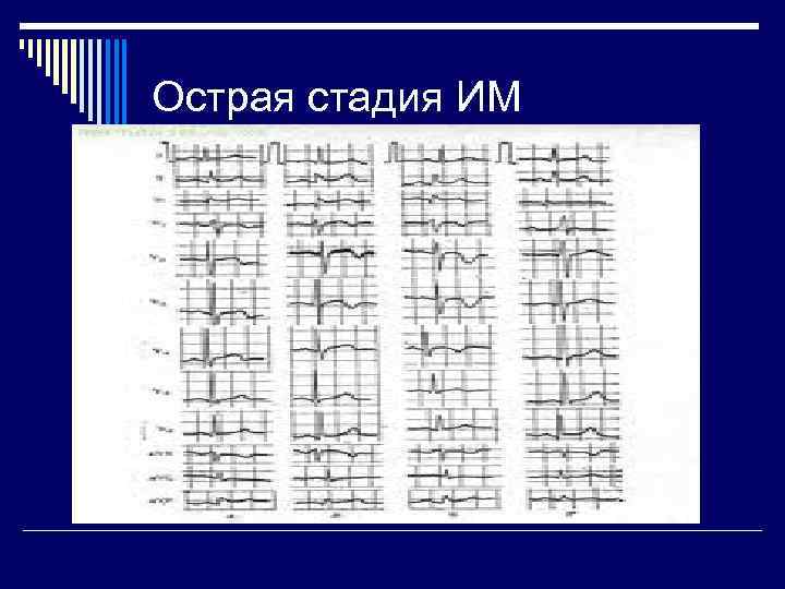 Острая стадия ИМ 