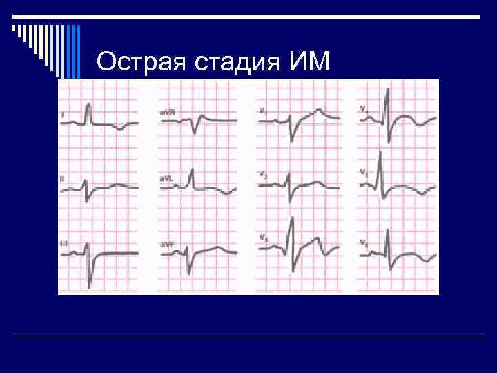 Острая стадия ИМ 