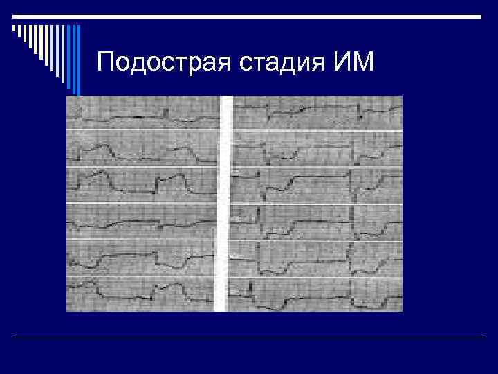 Подострая стадия ИМ 
