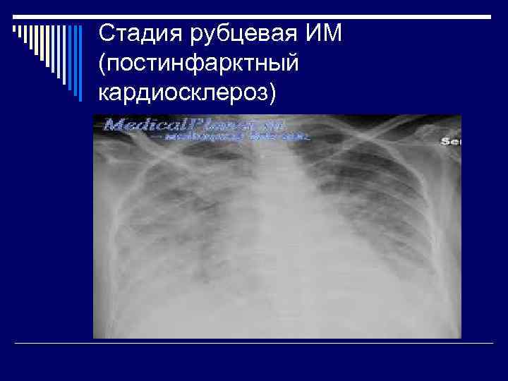 Постинфарктный кардиосклероз карта вызова скорой