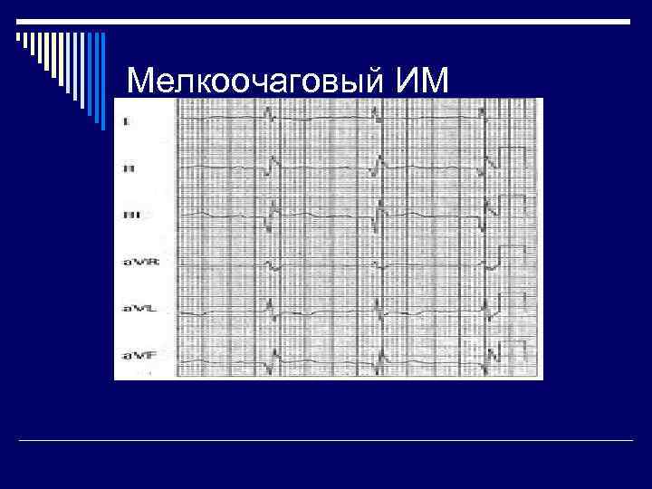 Мелкоочаговый ИМ 