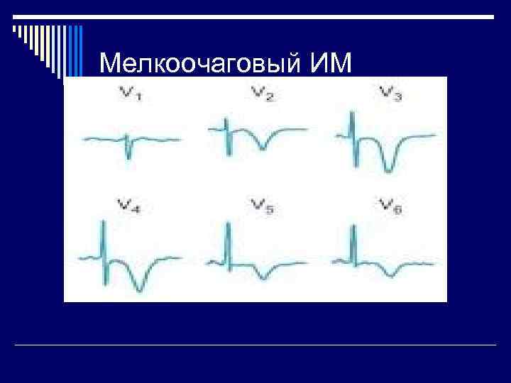 Мелкоочаговый ИМ 