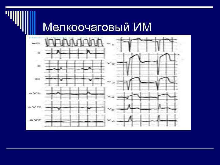 Мелкоочаговый ИМ 
