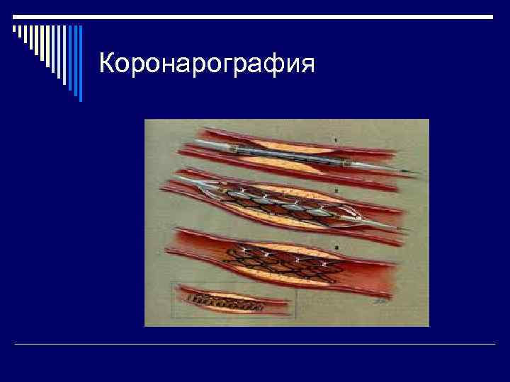 Коронарография 