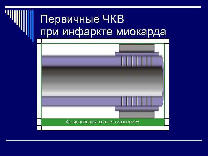 Первичные ЧКВ при инфаркте миокарда   Ангиопластика со стентированием 