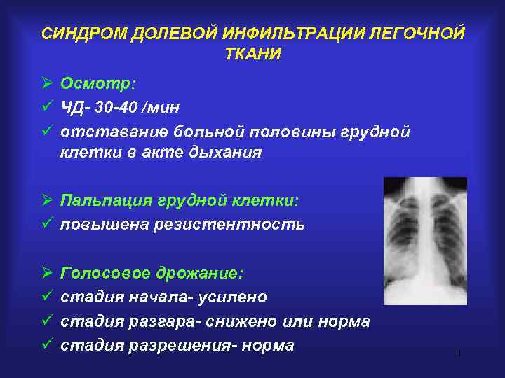 СИНДРОМ ДОЛЕВОЙ ИНФИЛЬТРАЦИИ ЛЕГОЧНОЙ   ТКАНИ Ø Осмотр: ü ЧД- 30 -40 /мин