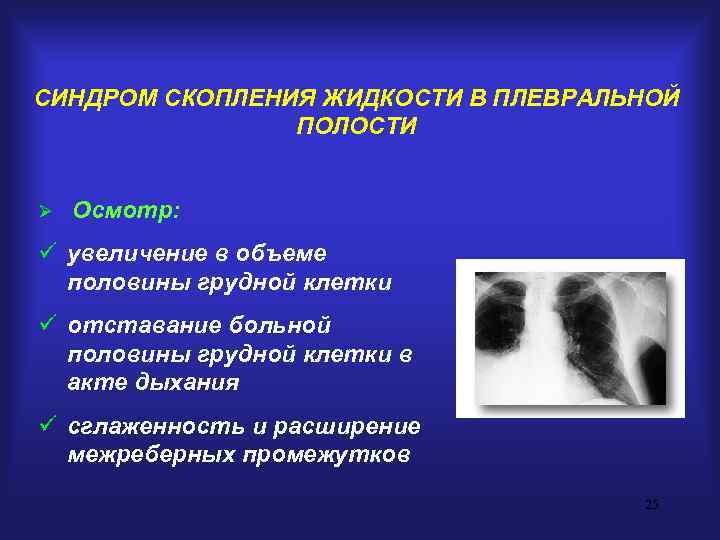 СИНДРОМ СКОПЛЕНИЯ ЖИДКОСТИ В ПЛЕВРАЛЬНОЙ   ПОЛОСТИ  Ø  Осмотр: ü увеличение