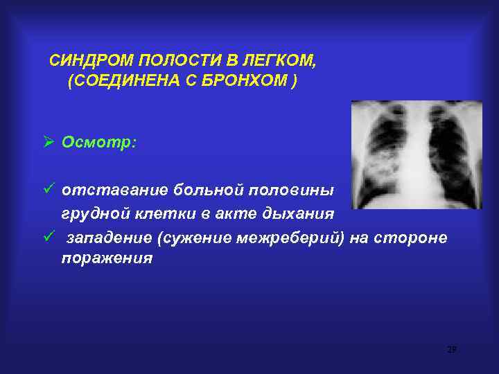 СИНДРОМ ПОЛОСТИ В ЛЕГКОМ,  (СОЕДИНЕНА С БРОНХОМ )  Ø Осмотр:  ü