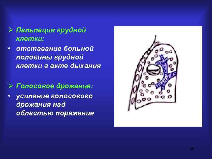 Ø Пальпация грудной  клетки:  • отставание больной  половины грудной  клетки