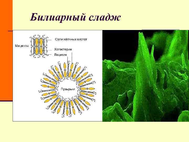 Билиарный сладж Билиарный сладж