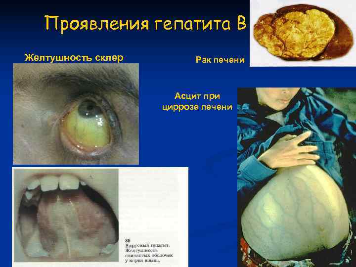   Проявления гепатита В Желтушность склер   Рак печени   