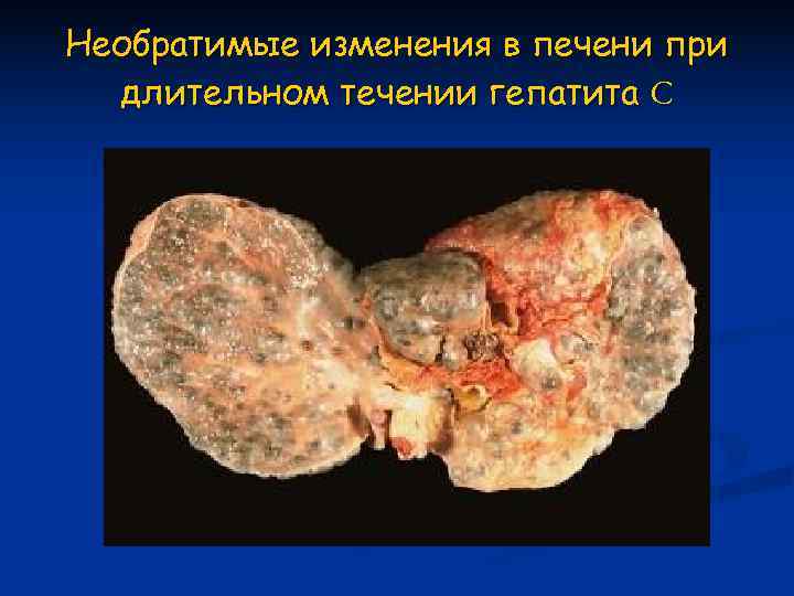 Необратимые изменения в печени при  длительном течении гепатита С 