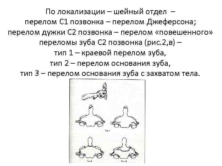    По локализации – шейный отдел – перелом С 1 позвонка –