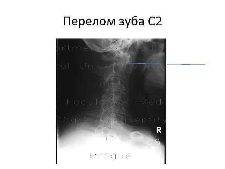 Перелом зуба С 2 