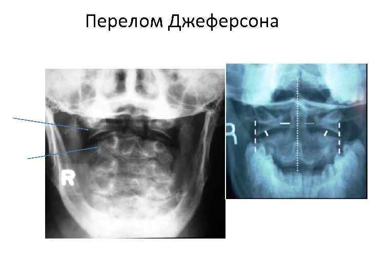 Перелом Джеферсона 