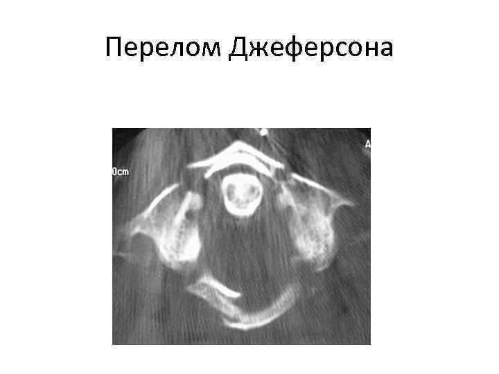 Перелом Джеферсона 