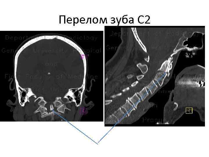 Перелом зуба С 2 