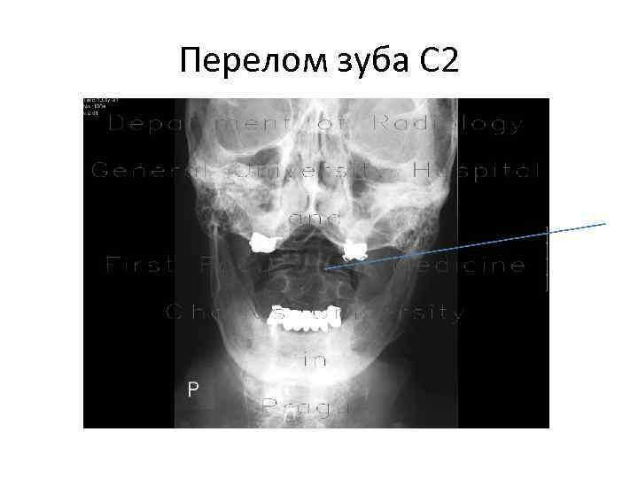 Перелом зуба С 2 
