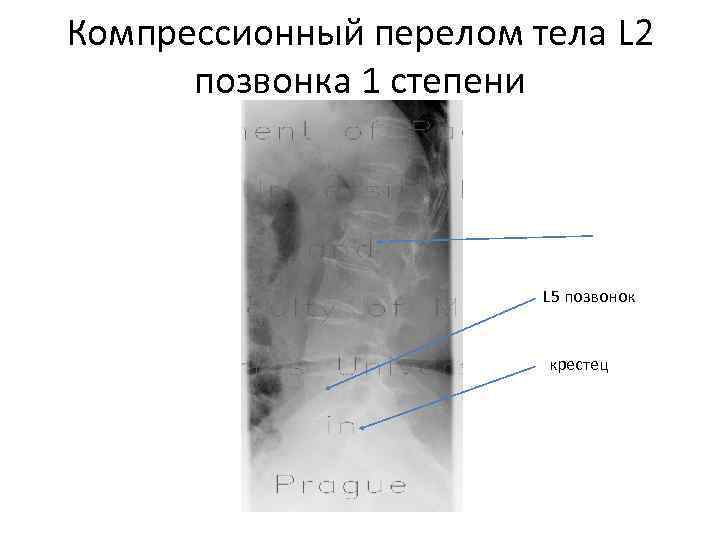 Компрессионный перелом l2 позвонка. Консолидированный компрессионный перелом тела позвонка l1. Компрессионный перелом позвоночника л2. Компрессионный перелом л2 позвонка.