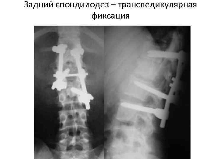 Задний спондилодез – транспедикулярная    фиксация 