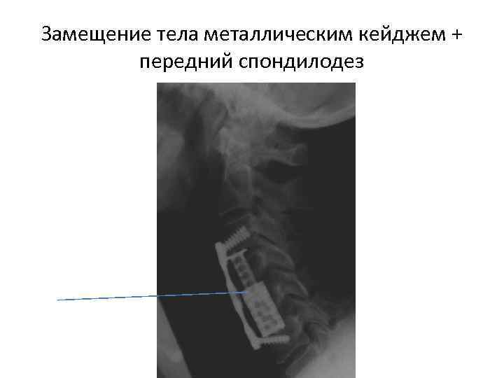 Замещение тела металлическим кейджем +   передний спондилодез 