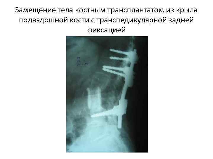 Замещение тела костным трансплантатом из крыла подвздошной кости с транспедикулярной задней   