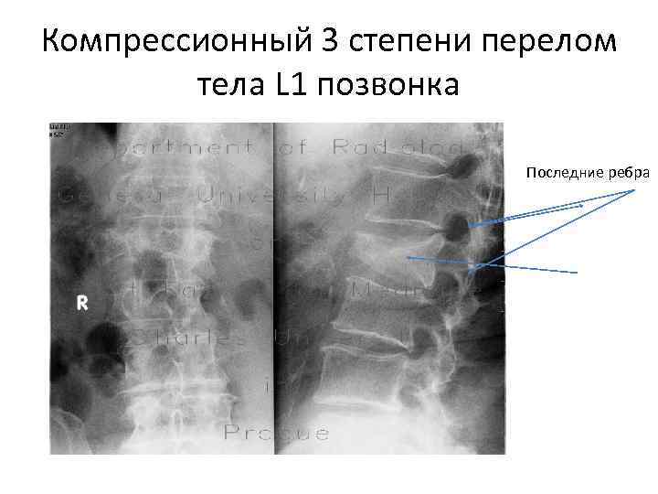 Компрессионный перелом позвоночника картинки