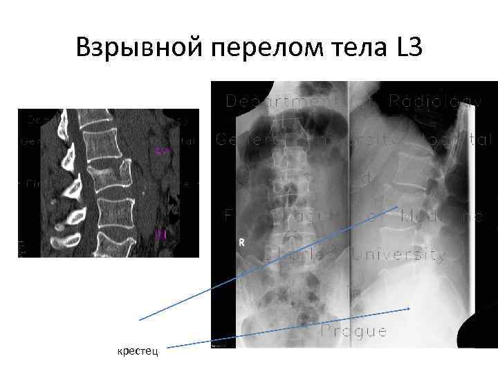 Взрывной перелом тела L 3  крестец 