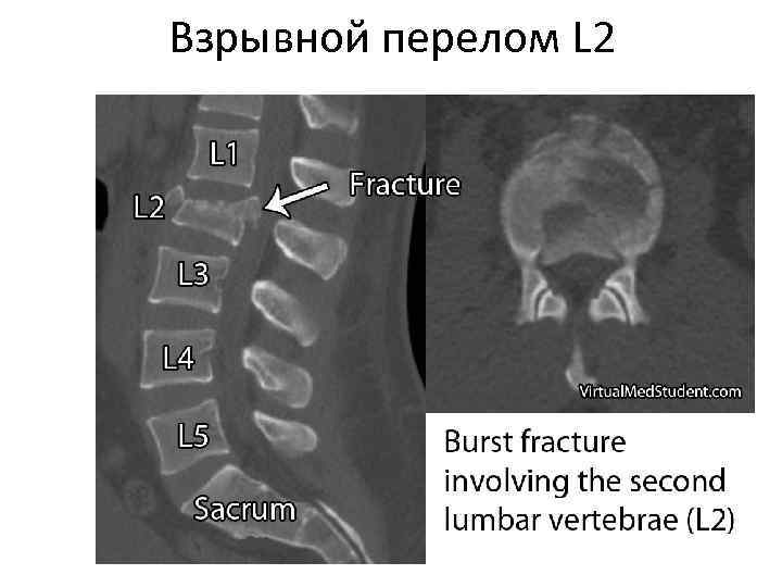 Взрывной перелом L 2 