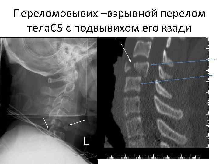 Переломовывих –взрывной перелом  тела. С 5 с подвывихом его кзади 