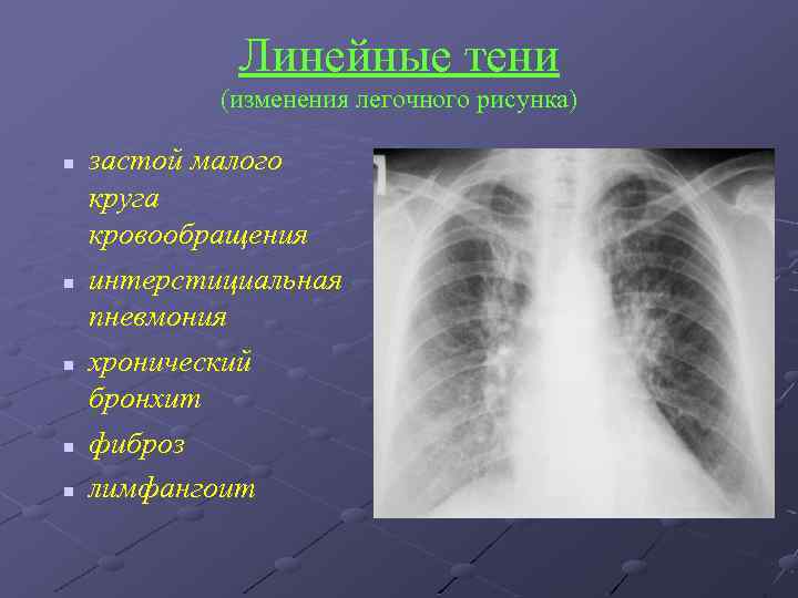 Линейные тени (изменения легочного рисунка) n n n застой малого круга кровообращения интерстициальная пневмония