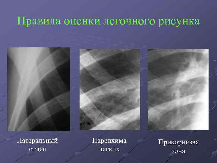 Легочный рисунок усилен в прикорневых зонах что