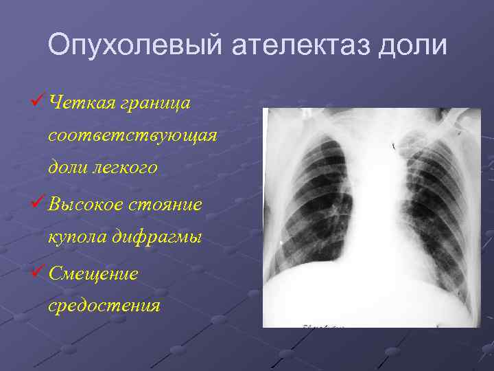 Опухолевый ателектаз доли ü Четкая граница соответствующая доли легкого ü Высокое стояние купола дифрагмы