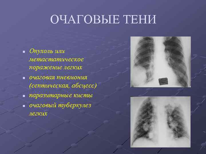 ОЧАГОВЫЕ ТЕНИ n n Опухоль или метастатическое поражение легких очаговая пневмония (септическая, абсцесс) паразитарные