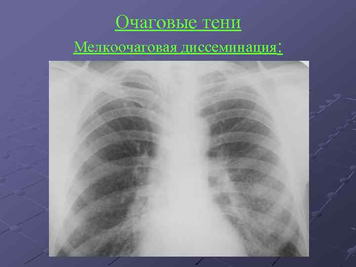 Очаговые тени Мелкоочаговая диссеминация: 