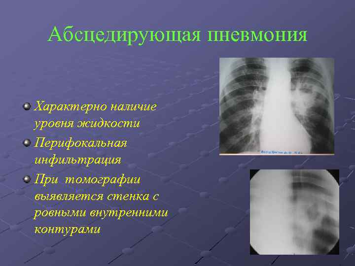 Абсцедирующая пневмония Характерно наличие уровня жидкости Перифокальная инфильтрация При томографии выявляется стенка с ровными
