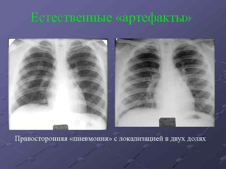 Естественные «артефакты» Правосторонняя «пневмония» с локализацией в двух долях 