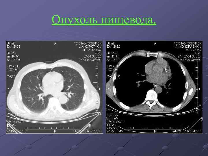 Опухоль пищевода. 