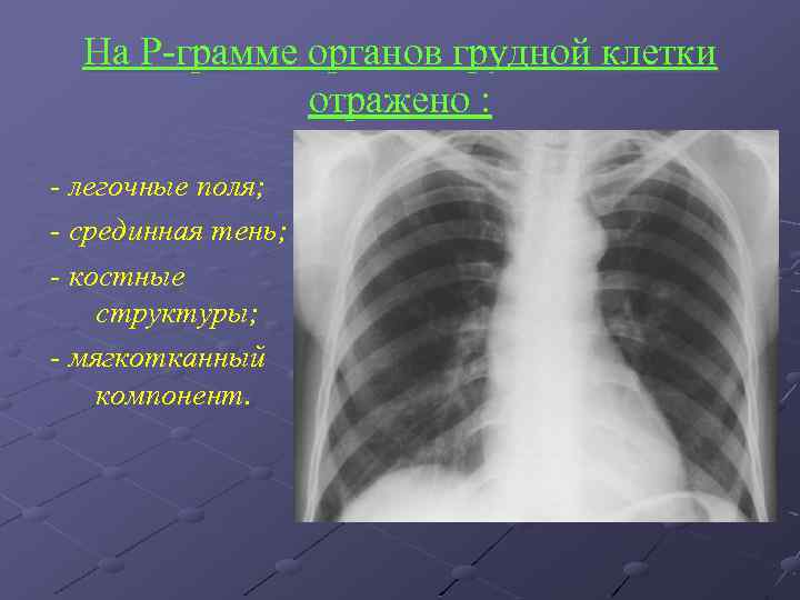 На Р-грамме органов грудной клетки отражено : - легочные поля; - срединная тень; -