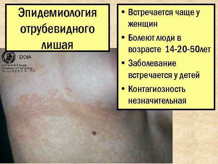 Эпидемиология  • Встречается чаще у    женщин отрубевидного   •