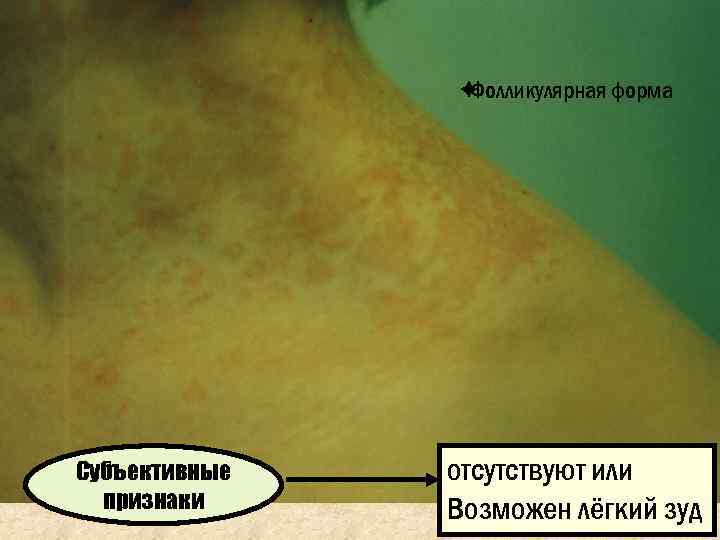     èФолликулярная форма Субъективные  отсутствуют или  признаки Возможен лёгкий