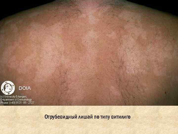 Отрубевидный лишай по типу витилиго 