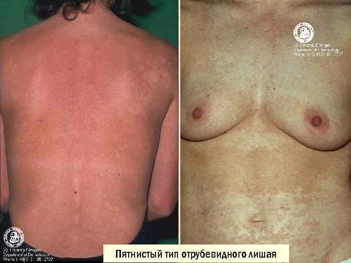 Пятнистый тип отрубевидного лишая 