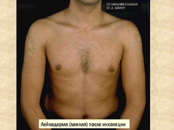 Лейкодерма (ложная) после инсоляции 