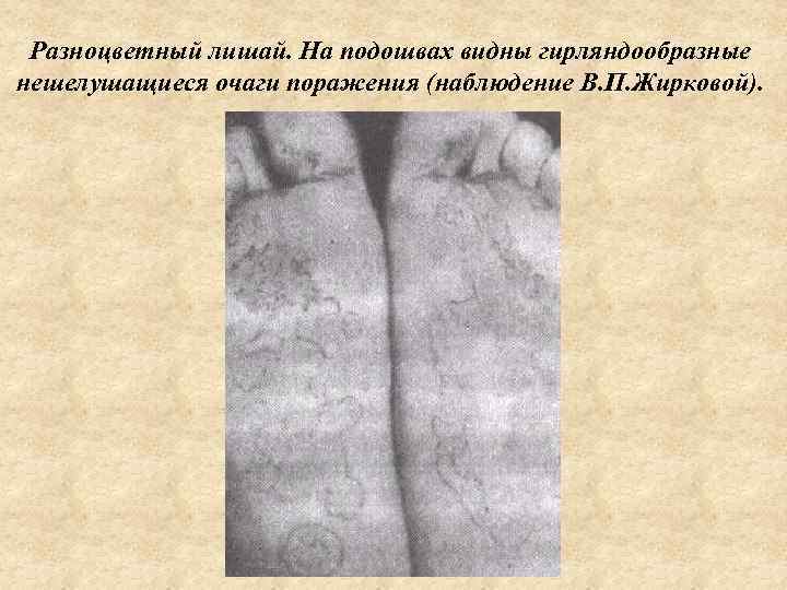  Разноцветный лишай. На подошвах видны гирляндообразные нешелушащиеся очаги поражения (наблюдение В. П. Жирковой).