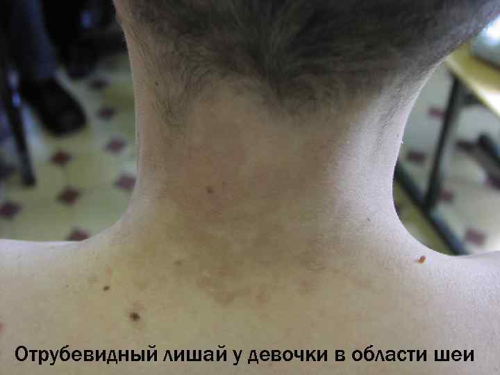 Отрубевидный лишай у девочки в области шеи 