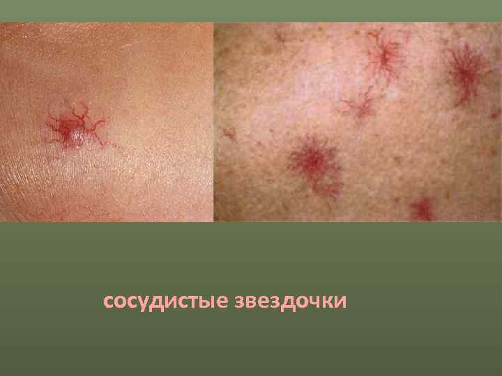 сосудистые звездочки 