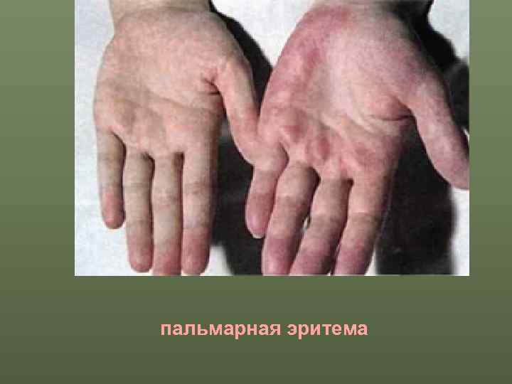 пальмарная эритема 