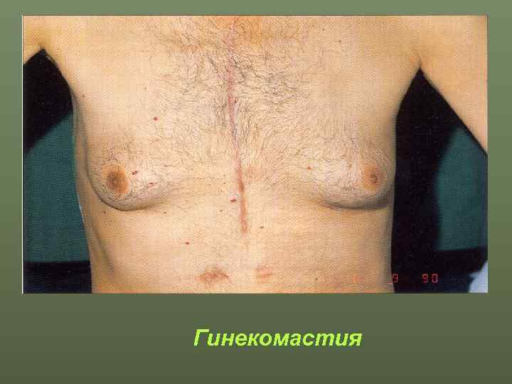 Гинекомастия 