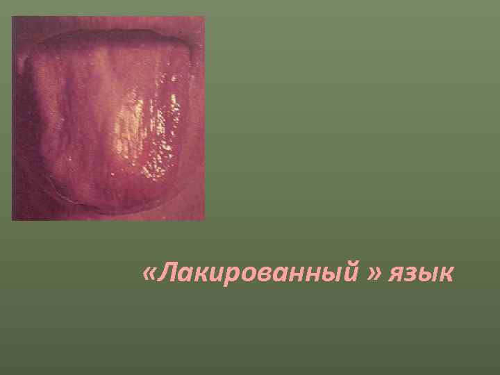  «Лакированный » язык 